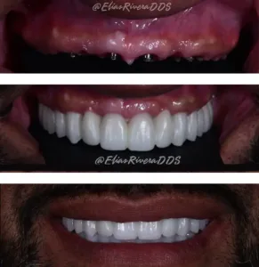 The FP1 Smile A Natural, Lasting Solution for Missing Teeth 🦷 Natural Look & Feel Designed to replicate the appearance and function of your own teeth — without the artificial look of bulky pink gum