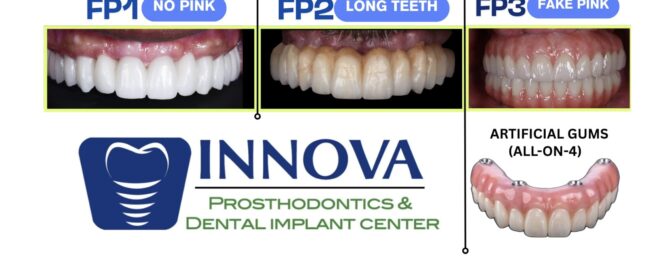 FP1 Smile full arch dental implant treatment options showing FP1 no pink, FP2 long teeth, and FP3 fake pink with artificial gums