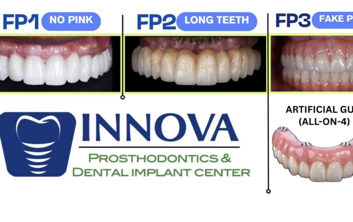 FP1 Smile full arch dental implant treatment options showing FP1 no pink, FP2 long teeth, and FP3 fake pink with artificial gums