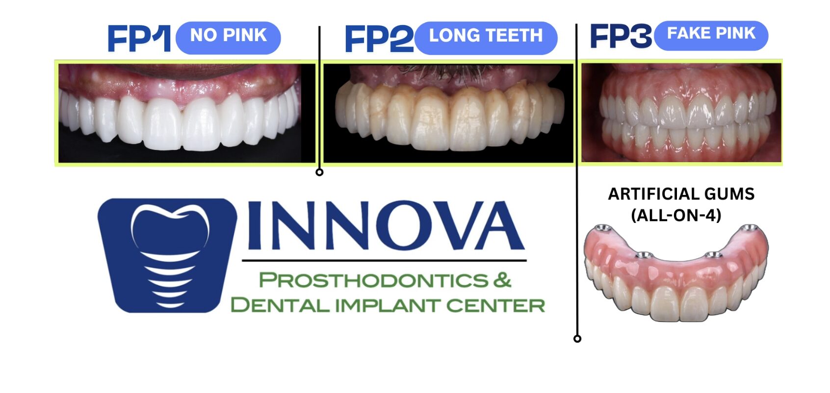 FP1 Smile full arch dental implant treatment options showing FP1 no pink, FP2 long teeth, and FP3 fake pink with artificial gums