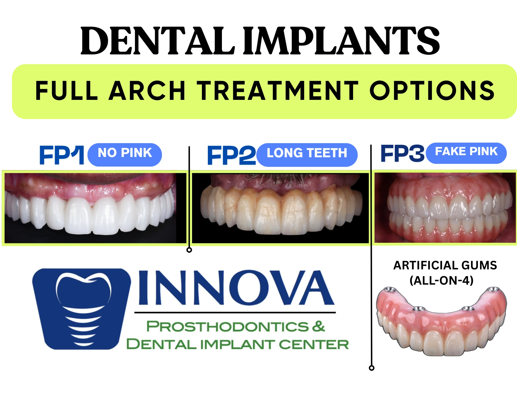 FP1 vs FP2 vs FP3 | Visual Comparison of Full-Arch Dental Implant Options