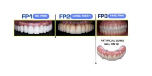 FP1 Smile clinic comparison of FP1, FP2, and FP3 dental implants with natural vs artificial gums