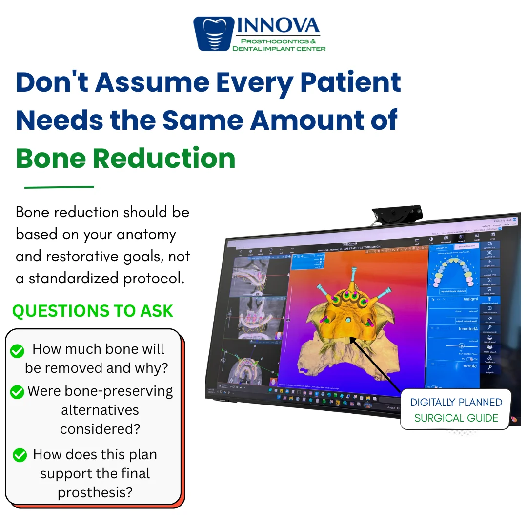 Does Every Full-Arch Dental Implant Patient Need Bone Reduction?